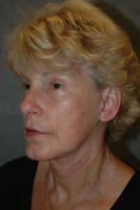 Facelift