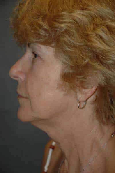 Facelift