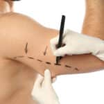 arm lift consultation