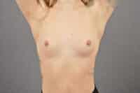 Breast Augmentation