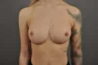 Breast Augmentation