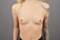 Breast Augmentation