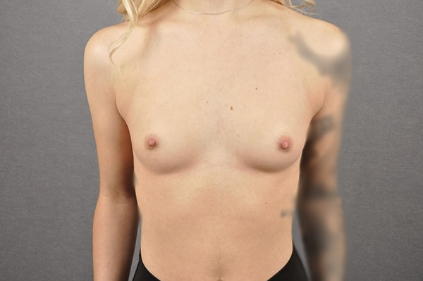 Breast Augmentation