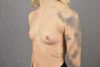 Breast Augmentation