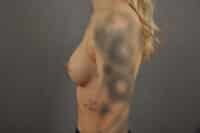 Breast Augmentation