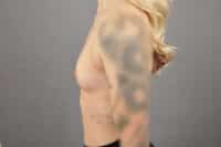 Breast Augmentation