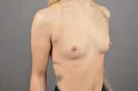 Breast Augmentation