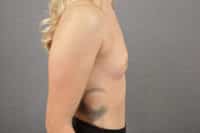 Breast Augmentation