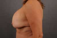 Breast Lift