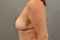 Breast Lift