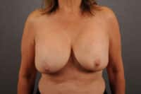 Breast Lift