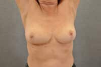 Breast Lift