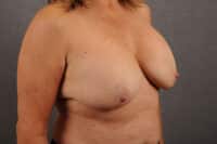 Breast Lift