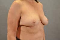 Breast Lift