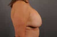 Breast Lift