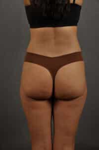 Liposuction