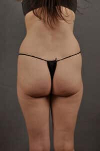 Liposuction