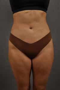 Liposuction