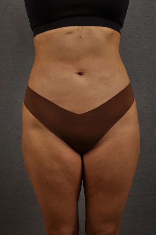 Liposuction