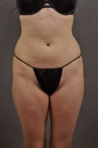 Liposuction