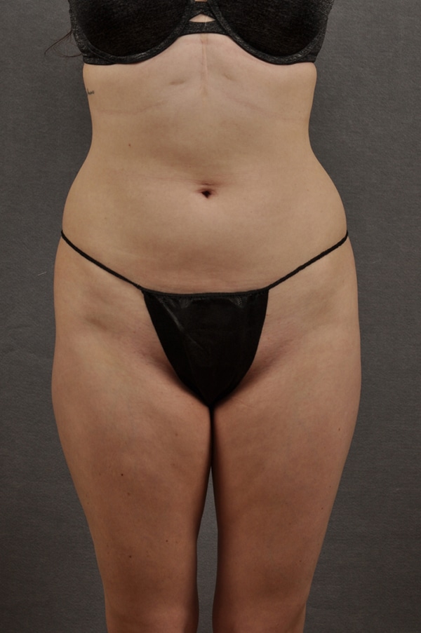 Liposuction