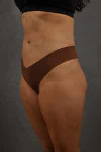 Liposuction
