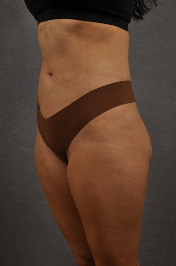 Liposuction