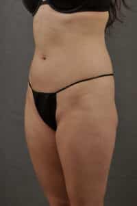Liposuction