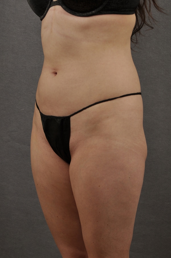 Liposuction