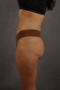 Liposuction