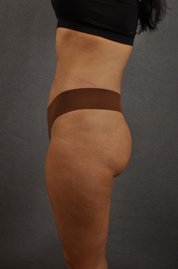 Liposuction