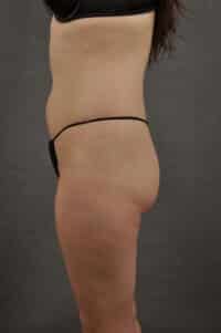 Liposuction