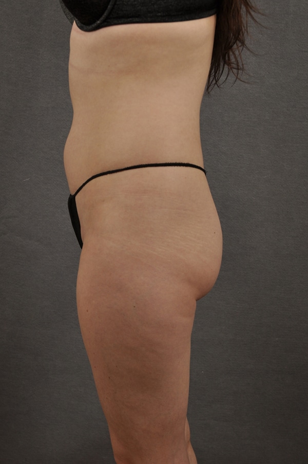 Liposuction