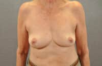 Breast Lift