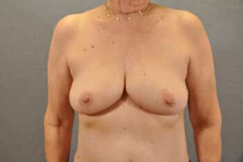 Breast Lift