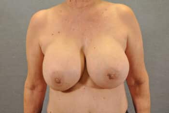 Breast Lift