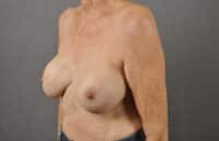 Breast Lift