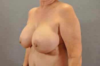 Breast Lift