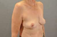 Breast Lift