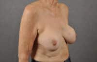 Breast Lift