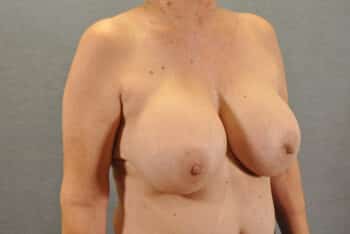 Breast Lift
