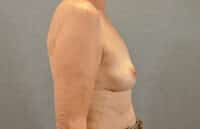 Breast Lift