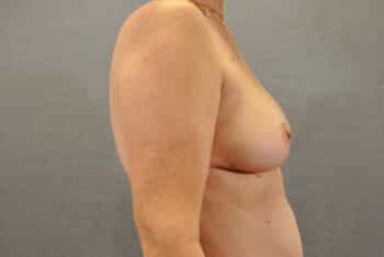 Breast Lift