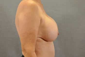Breast Lift
