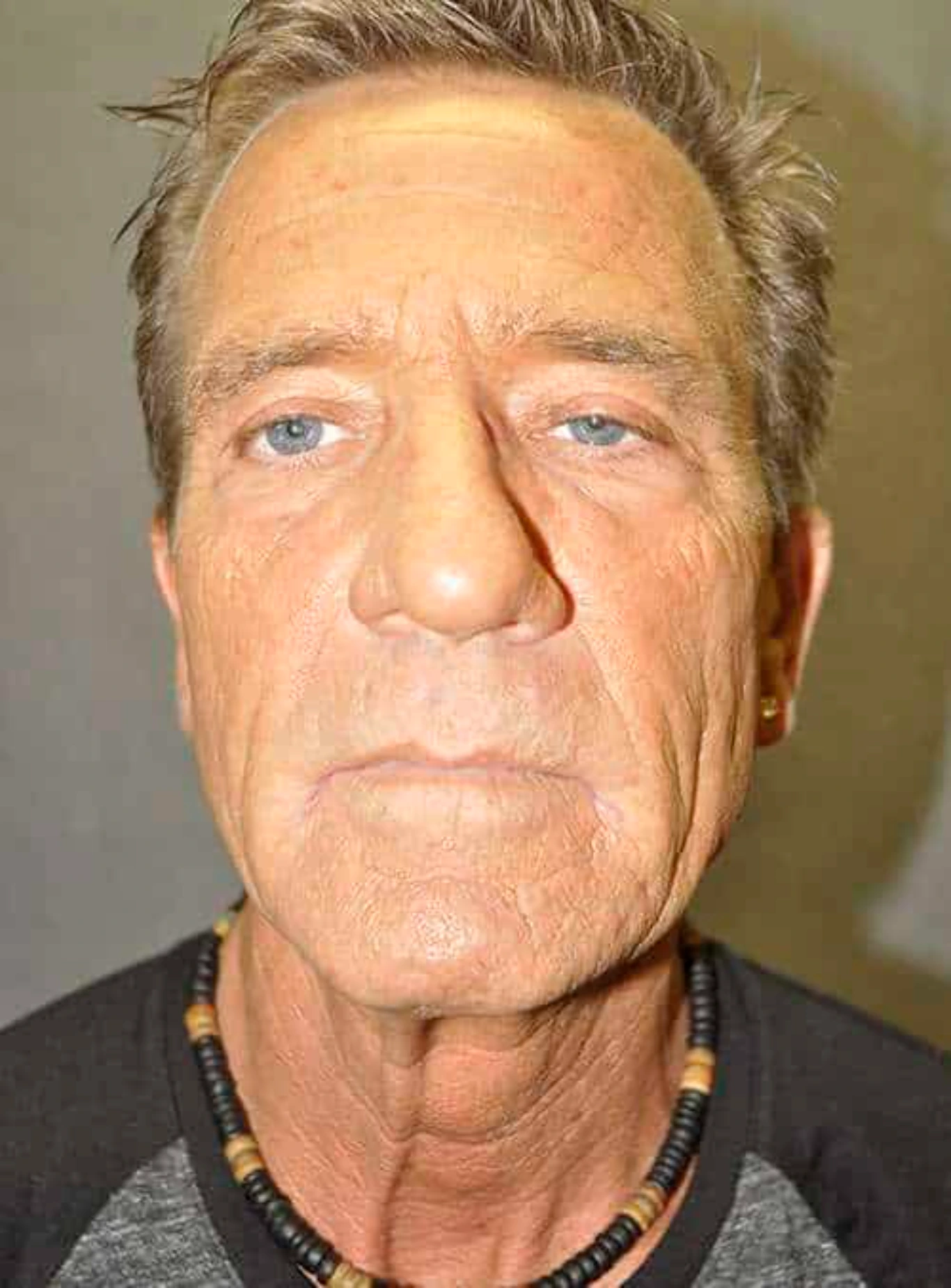 male facelift before and after results Male facelift before photo showing significant reduction in facial wrinkles and improved jawline definitions