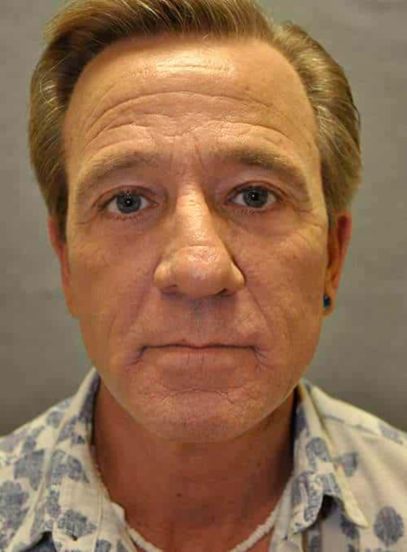 male facelift before and after results Male facelift after photos showing significant reduction in facial wrinkles and improved jawline definition